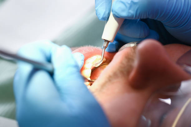 Best Emergency Dentist for Knocked-Out Tooth in Baton Rouge, LA
